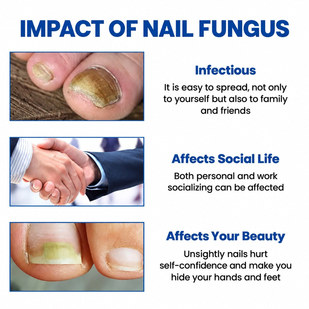 Efectos de los hongos en las uñas: contagio, vida social y estética