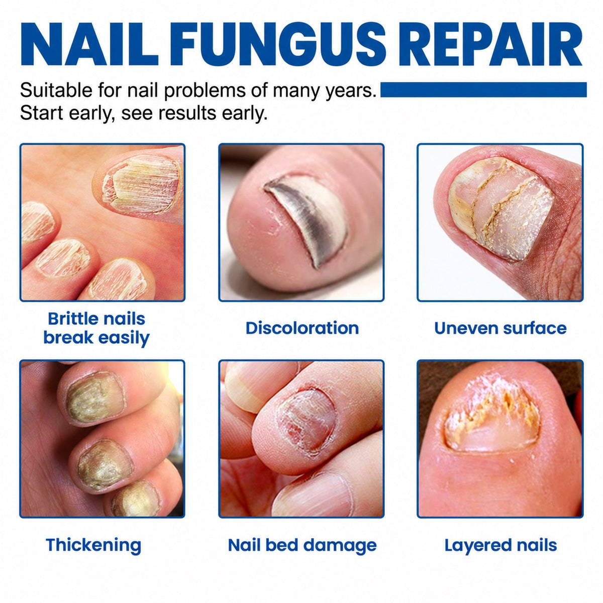 Reparación de uñas con hongos: uñas quebradizas, decoloradas, gruesas y con capas