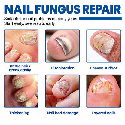 Reparación de uñas con hongos: uñas quebradizas, decoloradas, gruesas y con capas