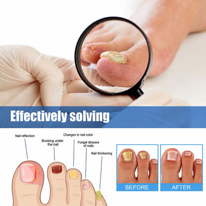 Solución eficaz para los problemas de uñas: antes y después