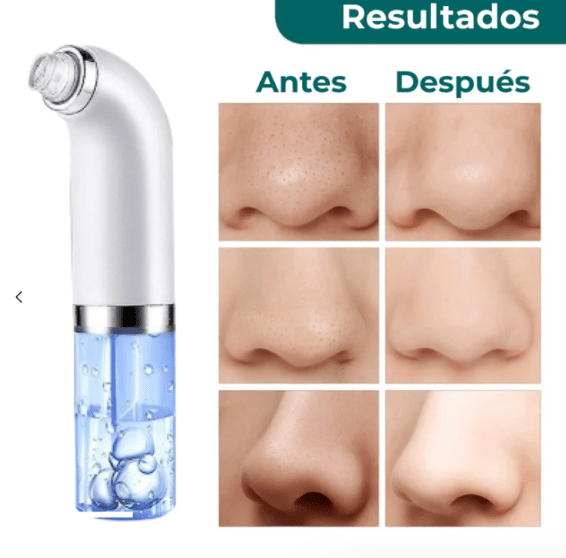 Lustrapore Hydro Suction Facial Cleaner Product Image 01