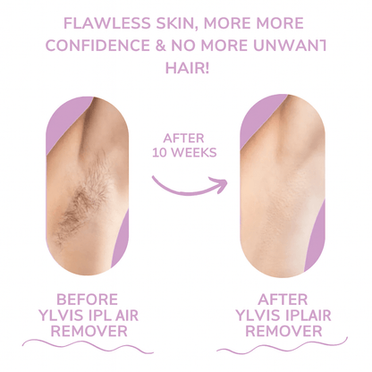 Vela Ipl Hair Removal Device Product Image 07